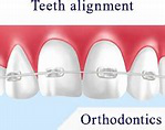 Teeth Alignment treatment